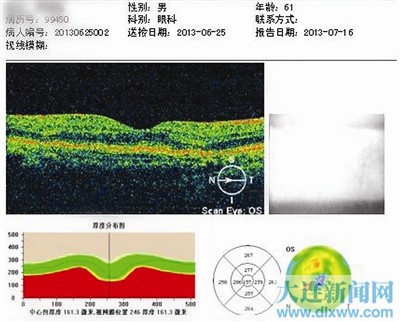 该患者治疗后的oct眼底检查图.