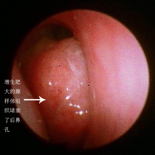 肥大的腺样体对比:正常的腺样体肥大的扁桃体