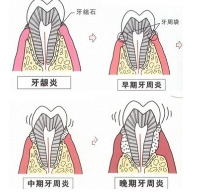 拜尔口腔牙周专家解析:如何预防糖 尿 病人牙周炎(图)