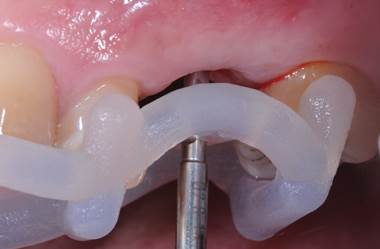 Stratasys 3D打印提高植牙手术精确度