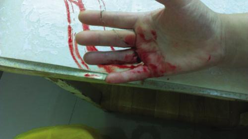 李娟的手被风筝线严重割伤.记者 于金来 摄