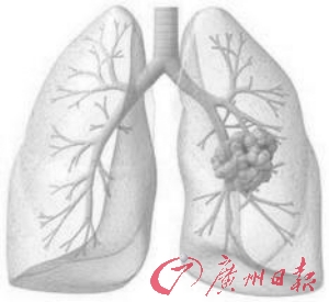 戒烟+低剂量螺旋CT=拒绝第一癌(组图)