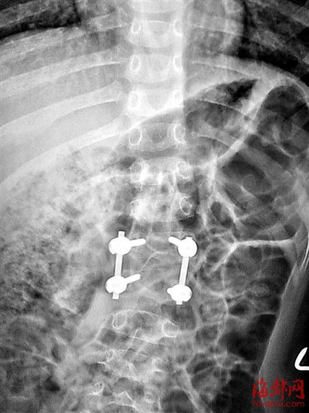 一个胸椎只长一半 3岁孩子天生驼背(组图)