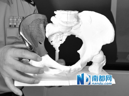技术制作的钛合金假体,分别植入3名骨肿瘤患者体内,修复其骨骼缺损