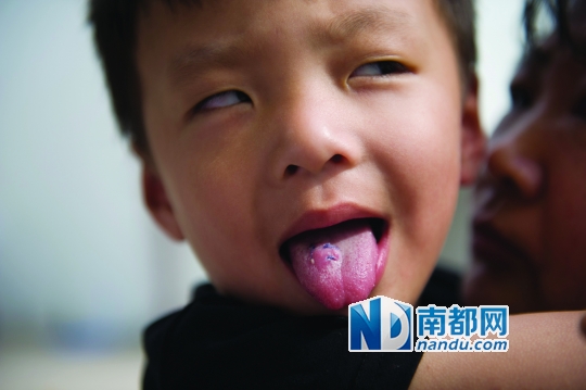 三龄童幼儿园中受伤舌头缝三针(图)