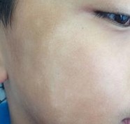 挑食女童脸上长白斑并非蛔虫所致 实为缺锌症状