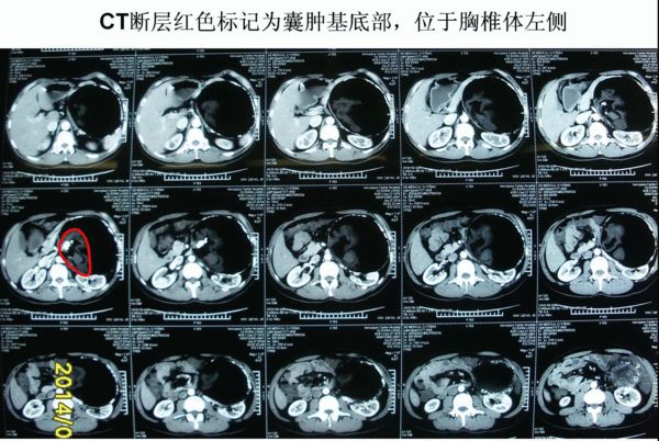 腹膜后肿瘤--成年男性腹膜后畸胎瘤