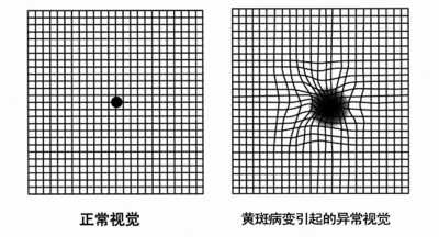 正常视觉所见.