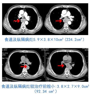 食管癌病人口水_食管癌晚期病人图片(3)