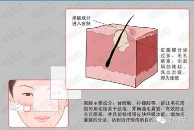 果酸换肤,完美解决各种肌肤问题