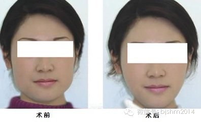 溶脂针vs瘦脸针~~不同之处有哪些?