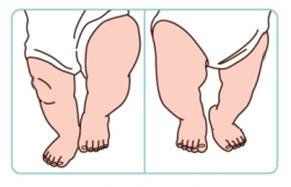 三种方法判断婴儿脚部是否异常