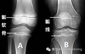 【基因营养学】怎样判断孩子还会不会长高?
