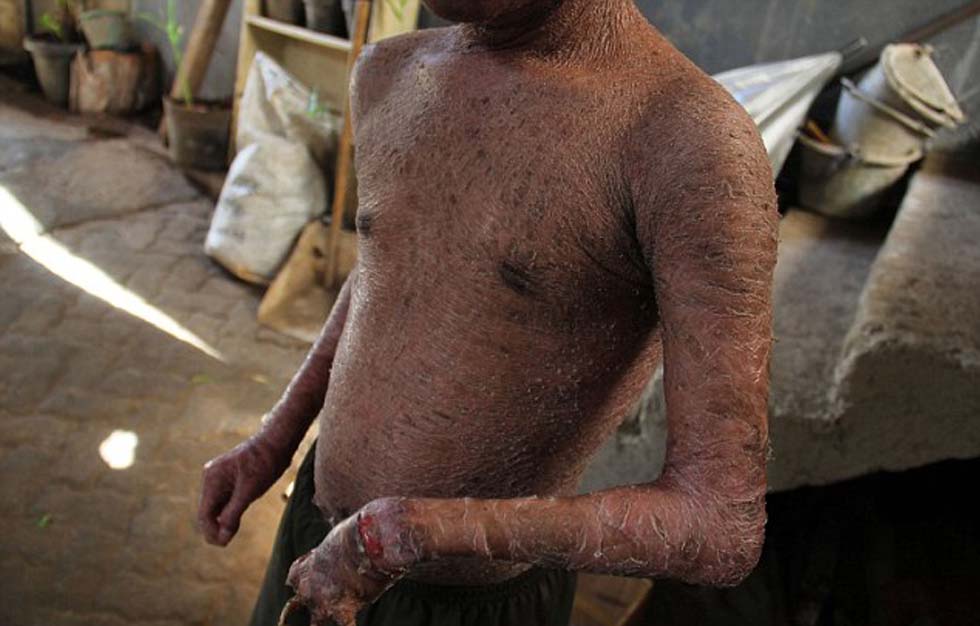 印尼蛇皮少年41天脱皮一次 每小时需泡热水