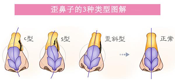 歪鼻子的分类