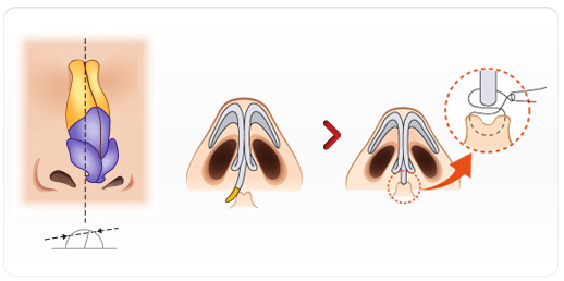 歪鼻矫正方法