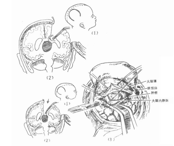 贺晓生教授讲肿瘤松果体瘤