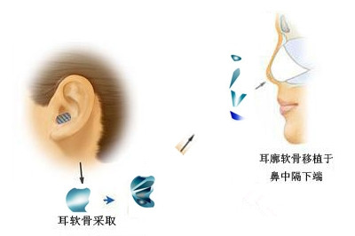 自体耳软骨隆鼻的四大优势