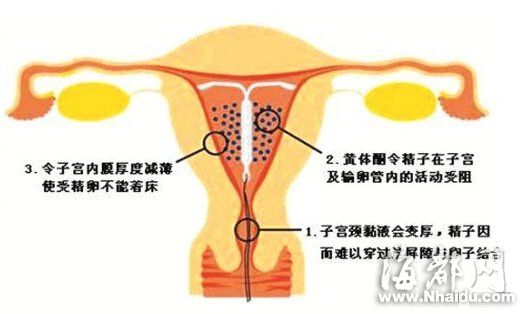 泉州:永春一妇女便血多日 体内取出3只避孕环