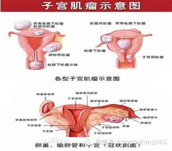 子宫肌瘤不要怕,调整心态科学应对