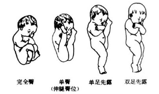 臀先露的种类臀位:如果胎儿头和臀颠倒过来,臀在下头在上,是臀先露