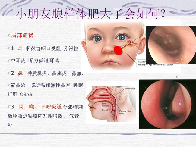 腺样体肥大-儿童鼻塞打鼾的主因