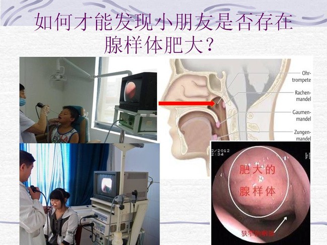 腺样体肥大-儿童鼻塞打鼾的主因