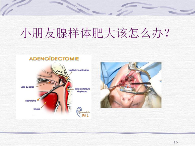 腺样体肥大-儿童鼻塞打鼾的主因