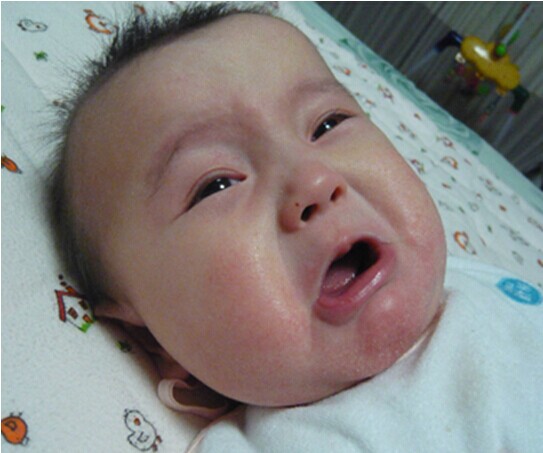 宝宝湿疹(图片来源于网络)