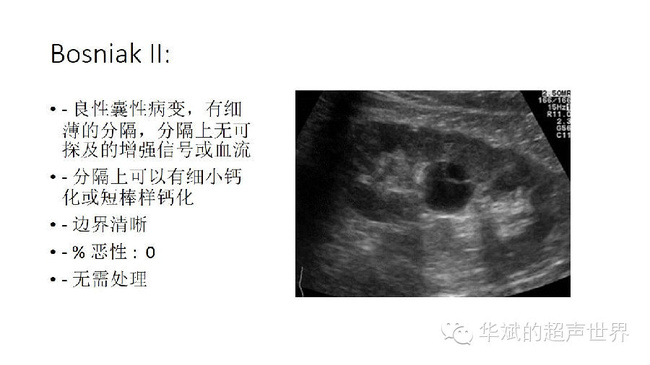 右肾囊肿伴钙化怎么办