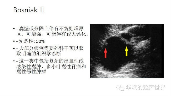 右肾囊肿伴钙化怎么办