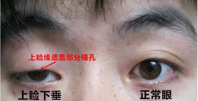 轻度:上睑遮住瞳孔的上1/3;中度:遮住瞳孔的1/2;重度:遮住瞳孔的1/2