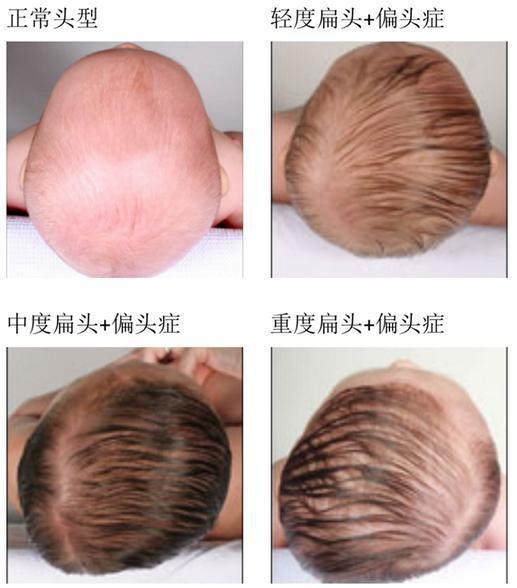 yycook365 →关注  假如2个月以后发现宝宝的头形不对称了,3个月以内