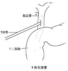 t型引流管,主要应用在胆总管切开取石或胆道探查术后.