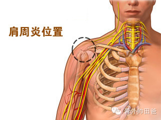 肩周炎又称"粘连性肩关节囊炎",主要表现为肩关节及其周围疼痛,影响肩