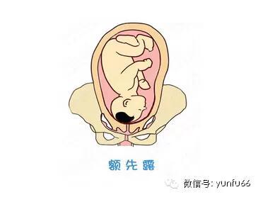 枕横位入盆的胎头侧屈以其前顶骨先入盆,称为前不均倾位.发生率为0.