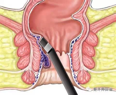 "菊部地区"有疼痛——痔疮