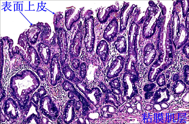 同样的道理,肠上皮化生的程度和胃癌是有关系的,当然这个也要做胃镜