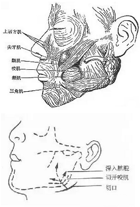 该手术的关键是去除的脂肪量要适度,以免损伤面部神经和腮腺导管.