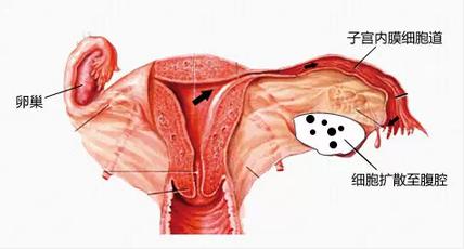 月经期间子宫内膜5mm_内膜5mm来月经正常吗_子宫内膜厚5mm