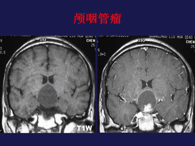 脑肿瘤影像及诊治