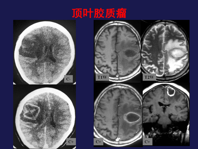 脑肿瘤影像及诊治