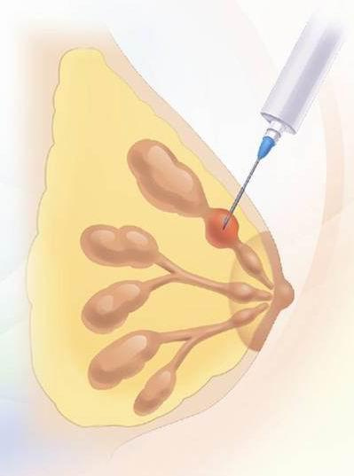 直面女性头号杀手:乳腺癌