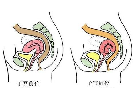 想要怀孕 子宫"位"要对"位"