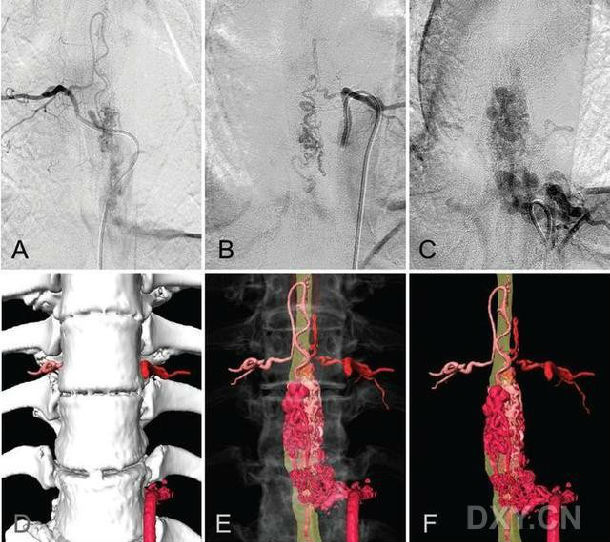 认识脊髓血管畸形