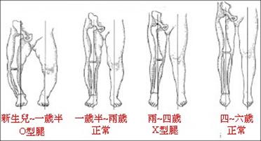 你家宝宝有o型腿,扁平足吗?30秒自我检测!