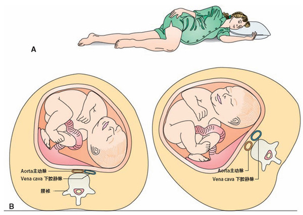怀孕中后期,左侧卧位有助于减轻增大的子宫对腹腔内深静脉的压迫