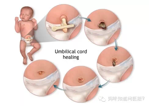 新生儿脐带要怎么护理?