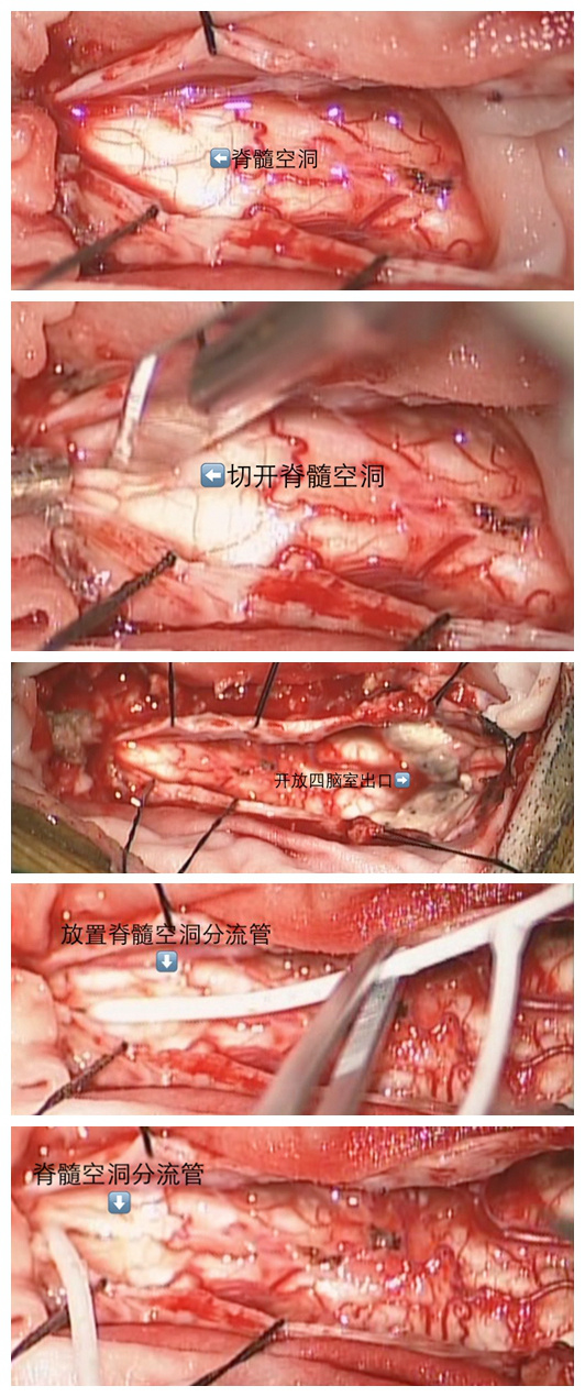 4,给脊髓安放一张大床 第四个手术:枕大池重建.