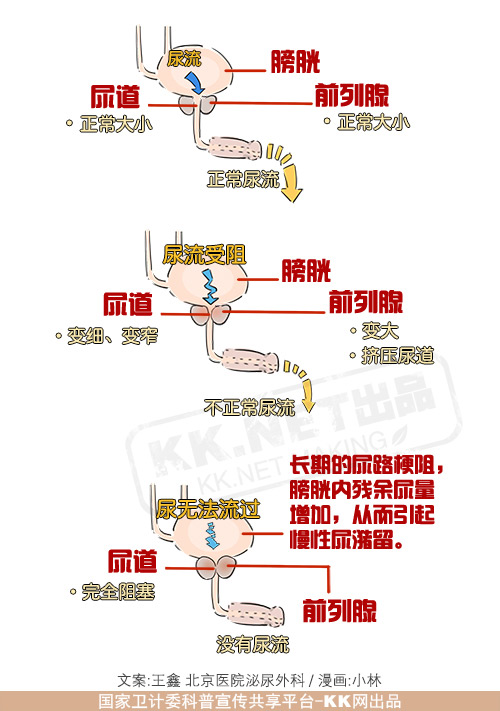 【图文解说】中老年男性应警惕前列腺增生-前列腺器官